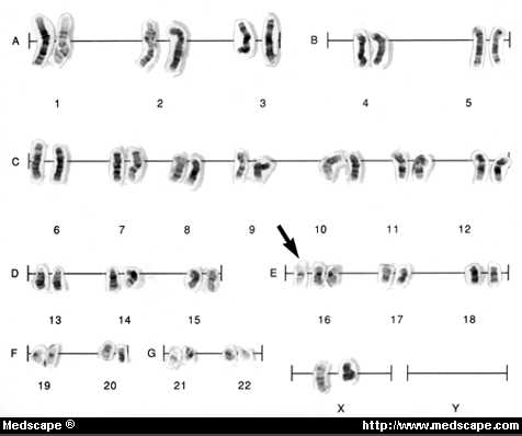 Karyotype of 47,XX+16 (trisomy 16), most common trisomy associated with spontaneous abortion. Recurrence risk for chromosomal anomaly in subsequent pregnancy is 1% or less.